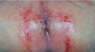 Adult Diaper Rash Treatment with Skiinprot