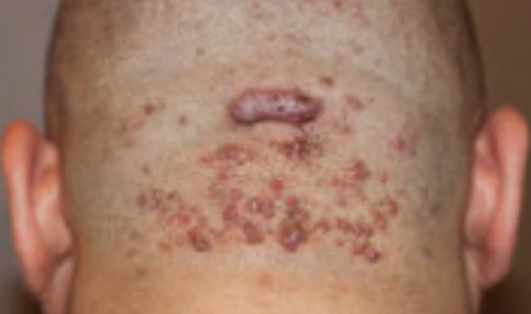 Keloid